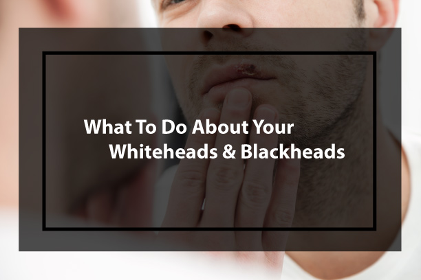 What To Do About Your Whiteheads & Blackheads