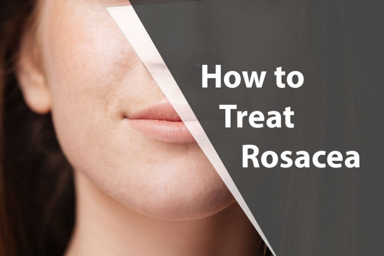 How To Treat Rosacea.
